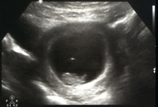Ultrasound 8 weeks 4 days